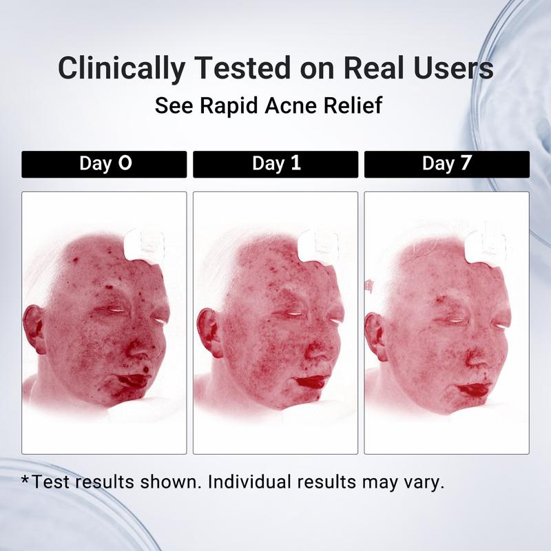 Dr.Leon Drying Lotion | Pimple, Body, Acne Treatment